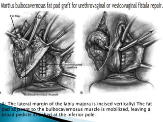 A: The lateral margin of the labia majora is incised vertically) The fat
pad adjacent to the bulbocavernosus muscle is mobilized, leaving a
broad pedicle attached at the inferior pole.
 