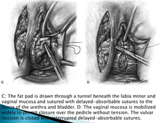 C: The fat pad is drawn through a tunnel beneath the labia minor and
vaginal mucosa and sutured with delayed-absorbable sutures to the
fascia of the urethra and bladder. D: The vaginal mucosa is mobilized
widely to permit closure over the pedicle without tension. The vulvar
incision is closed with interrupted delayed-absorbable sutures.
 