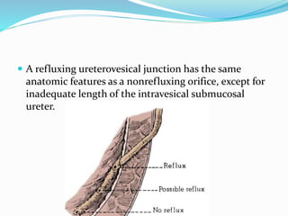  A refluxing ureterovesical junction has the same
anatomic features as a nonrefluxing orifice, except for
inadequate length of the intravesical submucosal
ureter.
 