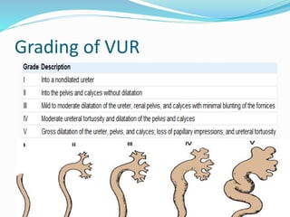 Grading of VUR
 