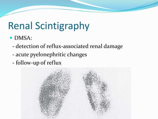 Renal Scintigraphy
 DMSA:
- detection of reflux-associated renal damage
- acute pyelonephritic changes
- follow-up of reflux
 