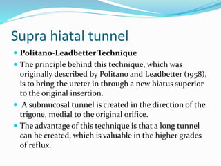 Supra hiatal tunnel
 Politano-Leadbetter Technique
 The principle behind this technique, which was
originally described by Politano and Leadbetter (1958),
is to bring the ureter in through a new hiatus superior
to the original insertion.
 A submucosal tunnel is created in the direction of the
trigone, medial to the original orifice.
 The advantage of this technique is that a long tunnel
can be created, which is valuable in the higher grades
of reflux.
 