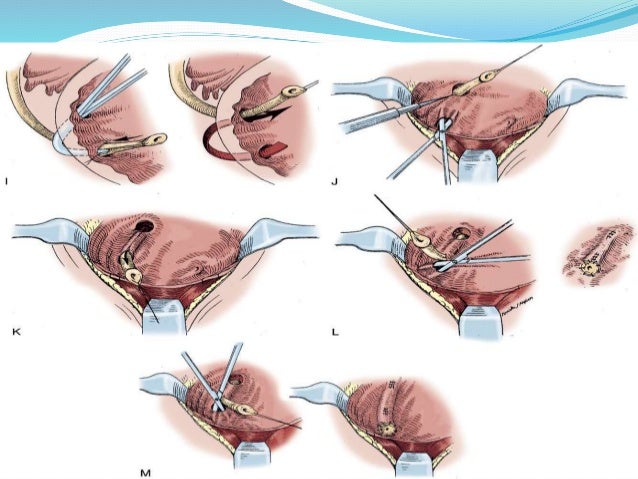 Vesicoureteral Reflux