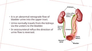 Vesicoureteral Reflux: Causes, Diagnosis, and Management | PPTX