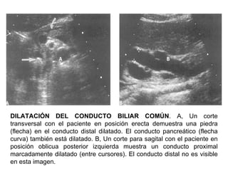 DILATACIÓN DEL CONDUCTO BILIAR COMÚN. A, Un corte
transversal con el paciente en posición erecta demuestra una piedra
(flecha) en el conducto distal dilatado. El conducto pancreático (flecha
curva) también está dilatado. B, Un corte para sagital con el paciente en
posición oblicua posterior izquierda muestra un conducto proximal
marcadamente dilatado (entre cursores). El conducto distal no es visible
en esta imagen.
 