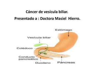 Cáncer de vesícula biliar.

Presentado a : Doctora Masiel Hierro.

 