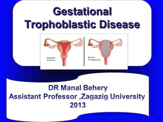 Gestational
Trophoblastic Disease
 