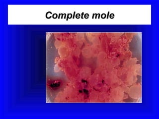 Complete mole
 