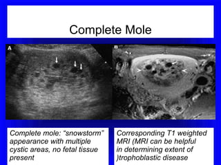 Complete Mole




Complete mole: “snowstorm”      Corresponding T1 weighted
appearance with multiple        MRI (MRI can be helpful
cystic areas, no fetal tissue   in determining extent of
present                         )trophoblastic disease
 