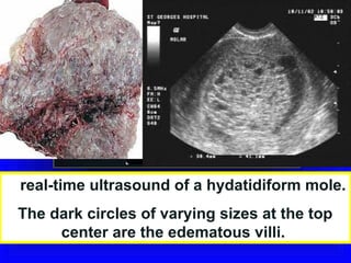A real-time ultrasound of a hydatidiform mole.
 The dark circles of varying sizes at the top
      center are the edematous villi.
 
