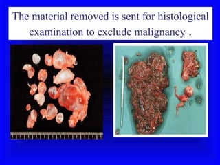 The material removed is sent for histological
   examination to exclude malignancy .
 
