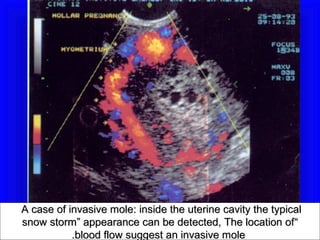 A case of invasive mole: inside the uterine cavity the typical
snow storm” appearance can be detected, The location of “
           .blood flow suggest an invasive mole
 