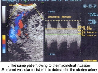 . The same patient owing to the myometrial invasion
.Reduced vascular resistance is detected in the uterine artery
 