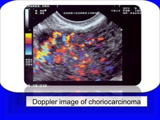 Doppler image of choriocarcinoma
 