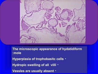 The microscopic appearance of hydatidiform
: mole
Hyperplasia of trophobasitc cells •
Hydropic swelling of all villi •
Vessles are usually absent •
 