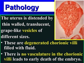 Pathology
The uterus is distended by
 thin walled, translucent,
grape-like vesicles of
different sizes.
• These are degenerated chorionic villi
  filled with fluid.
• There is no vasculature in the chorionic
  villi leads to early death of the embryo.
 