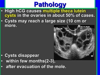 Pathology
• High hCG causes multiple theca lutein
  cysts in the ovaries in about 50% of cases.
• Cysts may reach a large size (10 cm or
  more.




• Cysts disappear
• within few months(2-3),
• after evacuation of the mole.
 