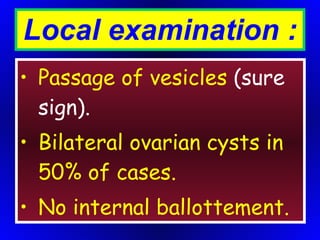 Local examination : Passage of vesicles  (sure sign). Bilateral ovarian cysts in 50% of cases. No internal ballottement. 