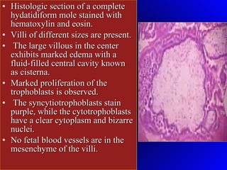 Histologic section of a complete hydatidiform mole stained with hematoxylin and eosin.  Villi of different sizes are present. The large villous in the center exhibits marked edema with a fluid-filled central cavity known as cisterna.  Marked proliferation of the trophoblasts is observed. The syncytiotrophoblasts stain purple, while the cytotrophoblasts have a clear cytoplasm and bizarre nuclei.  No fetal blood vessels are in the mesenchyme of the villi.  