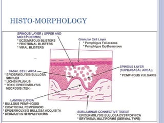 Bullous Rash Pathology VESICULAR AND BULLOUS LESIONS OF SKIN (2).pptx