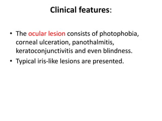 Clinical features:
• The ocular lesion consists of photophobia,
corneal ulceration, panothalmitis,
keratoconjunctivitis and even blindness.
• Typical iris-like lesions are presented.
 