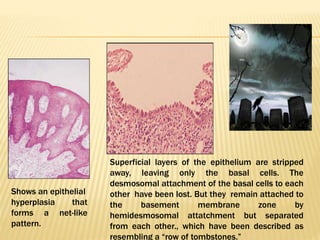 ORAL VESICULOBULLOUS LESION | PPTX