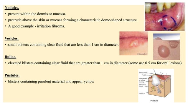 Vesiculobullous Lesion Of Oral Cavity pptx Vesiculobullous Lesion Of Oral Cavity pptx