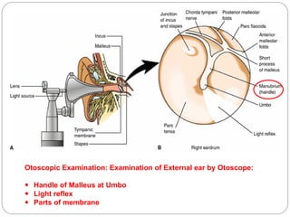Otoscopic Examination: Examination of External ear by Otoscope:
 Handle of Malleus at Umbo
 Light reflex
 Parts of membrane
 