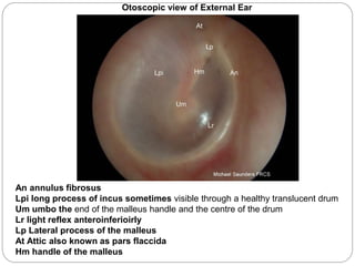 An annulus fibrosus
Lpi long process of incus sometimes visible through a healthy translucent drum
Um umbo the end of the malleus handle and the centre of the drum
Lr light reflex anteroinferioirly
Lp Lateral process of the malleus
At Attic also known as pars flaccida
Hm handle of the malleus
Otoscopic view of External Ear
 