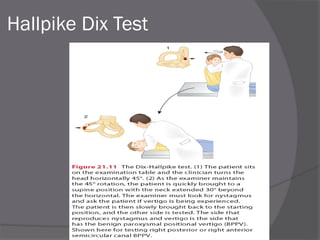 Hallpike Dix Test
 