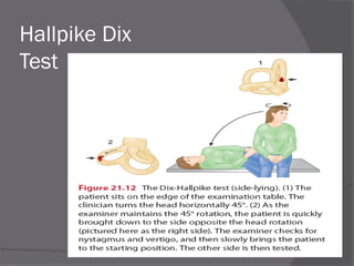 Hallpike Dix
Test
 