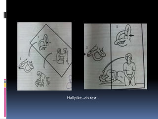 Hallpike –dix test
 