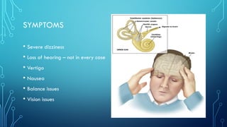 SYMPTOMS
• Severe dizziness
• Loss of hearing – not in every case
• Vertigo
• Nausea
• Balance issues
• Vision issues
 