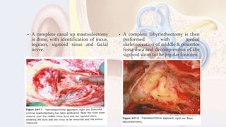• A complete canal up mastoidectomy
is done, with identification of incus,
tegmen, sigmoid sinus and facial
nerve.
• A complete labyrinthectomy is then
performed with medial
skeletonization of middle & posterior
fossa dura and decompression of the
sigmoid sinus to the jugular foramen.
 
