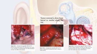 Tumor removal is done from
lateral to medial along the
IAC.
 