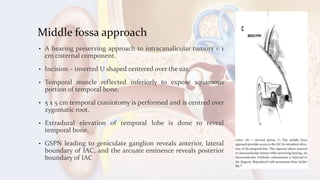 Middle fossa approach
• A hearing preserving approach to intracanalicular tumors < 1
cm cisternal component.
• Incision – inverted U shaped centered over the ear.
• Temporal muscle reflected inferiorly to expose squamous
portion of temporal bone.
• 5 x 5 cm temporal craniotomy is performed and is centred over
zygomatic root.
• Extradural elevation of temporal lobe is done to reveal
temporal bone.
• GSPN leading to geniculate ganglion reveals anterior, lateral
boundary of IAC, and the arcuate eminence reveals posterior
boundary of IAC
 