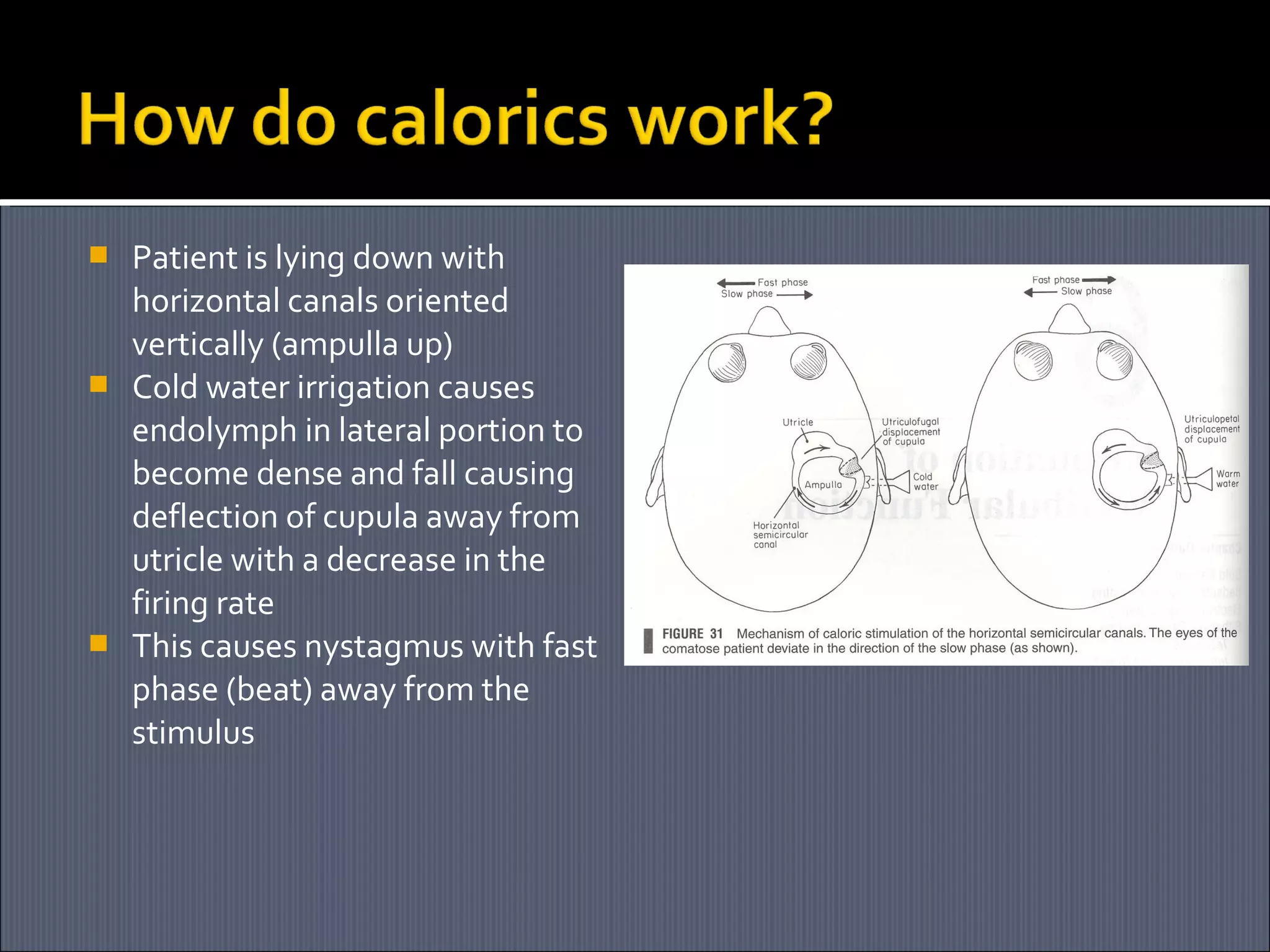 





Patient is lying down with
horizontal canals oriented
vertically (ampulla up)
Cold water irrigation causes
endolymph in lateral portion to
become dense and fall causing
deflection of cupula away from
utricle with a decrease in the
firing rate
This causes nystagmus with fast
phase (beat) away from the
stimulus

 