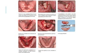 Vestibuloplastia y torus