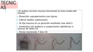 TECNIC
AS
Se realiza incisión mucosa horizontal en línea media del
maxilar
 Disección supraperiostica con tijeras.
 Liberar tejidos submucosos
 Se fija mucosa en su posición vestibular mas alta(1)
 Inmoviliza con prótesis y suspensiones alámbricas o
suturas de nylon (2)
 Férula mantenida 7 días (3)
 