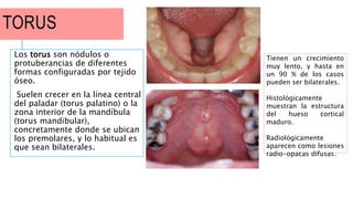 TORUS
Los torus son nódulos o
protuberancias de diferentes
formas configuradas por tejido
óseo.
Suelen crecer en la línea central
del paladar (torus palatino) o la
zona interior de la mandíbula
(torus mandibular),
concretamente donde se ubican
los premolares, y lo habitual es
que sean bilaterales.
Tienen un crecimiento
muy lento, y hasta en
un 90 % de los casos
pueden ser bilaterales.
Histológicamente
muestran la estructura
del hueso cortical
maduro.
Radiológicamente
aparecen como lesiones
radio-opacas difusas.
 