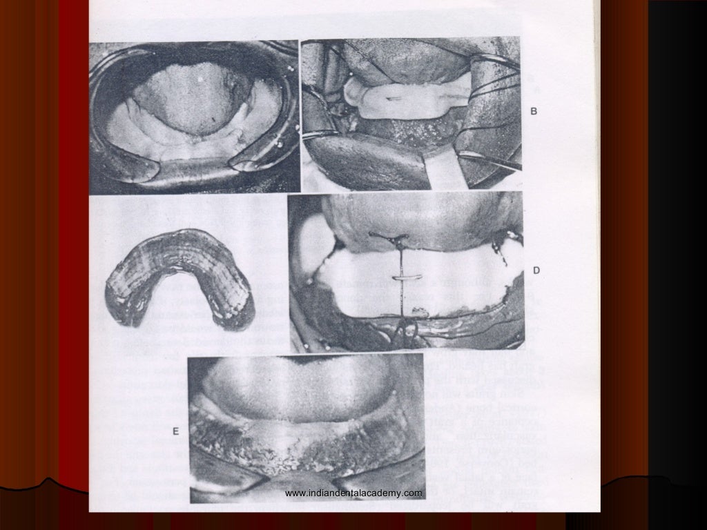 Vestibuloplasty/certified fixed orthodontic courses by Indian dental