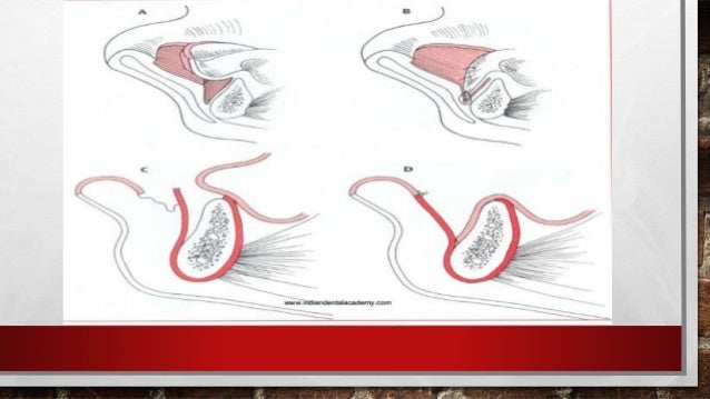 vestibuloplasty indications vestibuloplasty vestibuloplasty indications vestibuloplasty