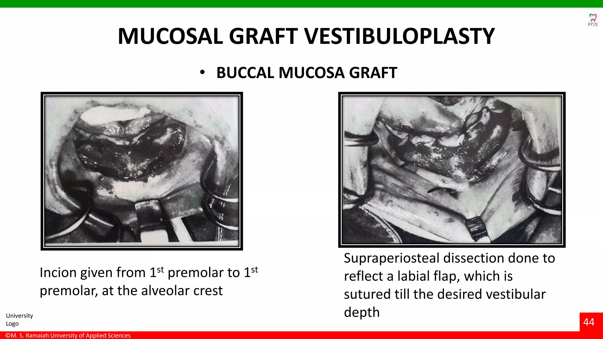 Vestibuloplasty- ridge extension procedures | PPTX