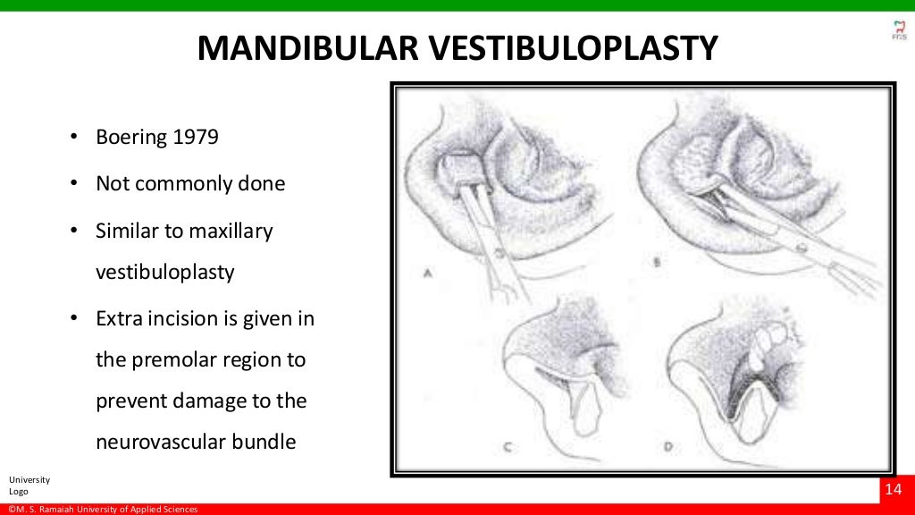 Vestibuloplasty ridge extension procedures