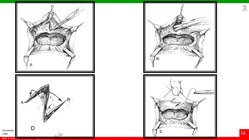 Vestibuloplasty ridge extension procedures