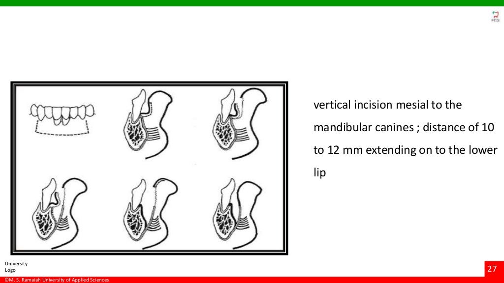 Vestibuloplasty ridge extension procedures