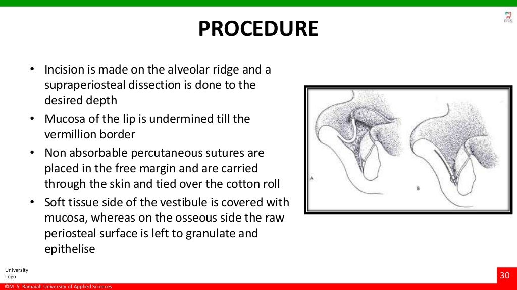 Vestibuloplasty ridge extension procedures