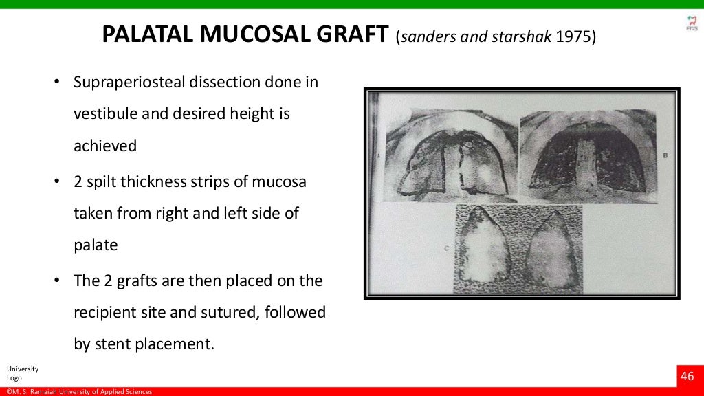 Vestibuloplasty ridge extension procedures