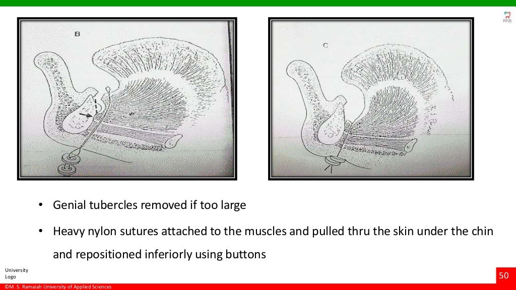 Vestibuloplasty ridge extension procedures