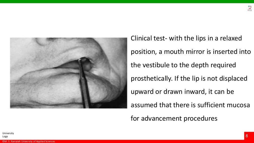 Vestibuloplasty ridge extension procedures